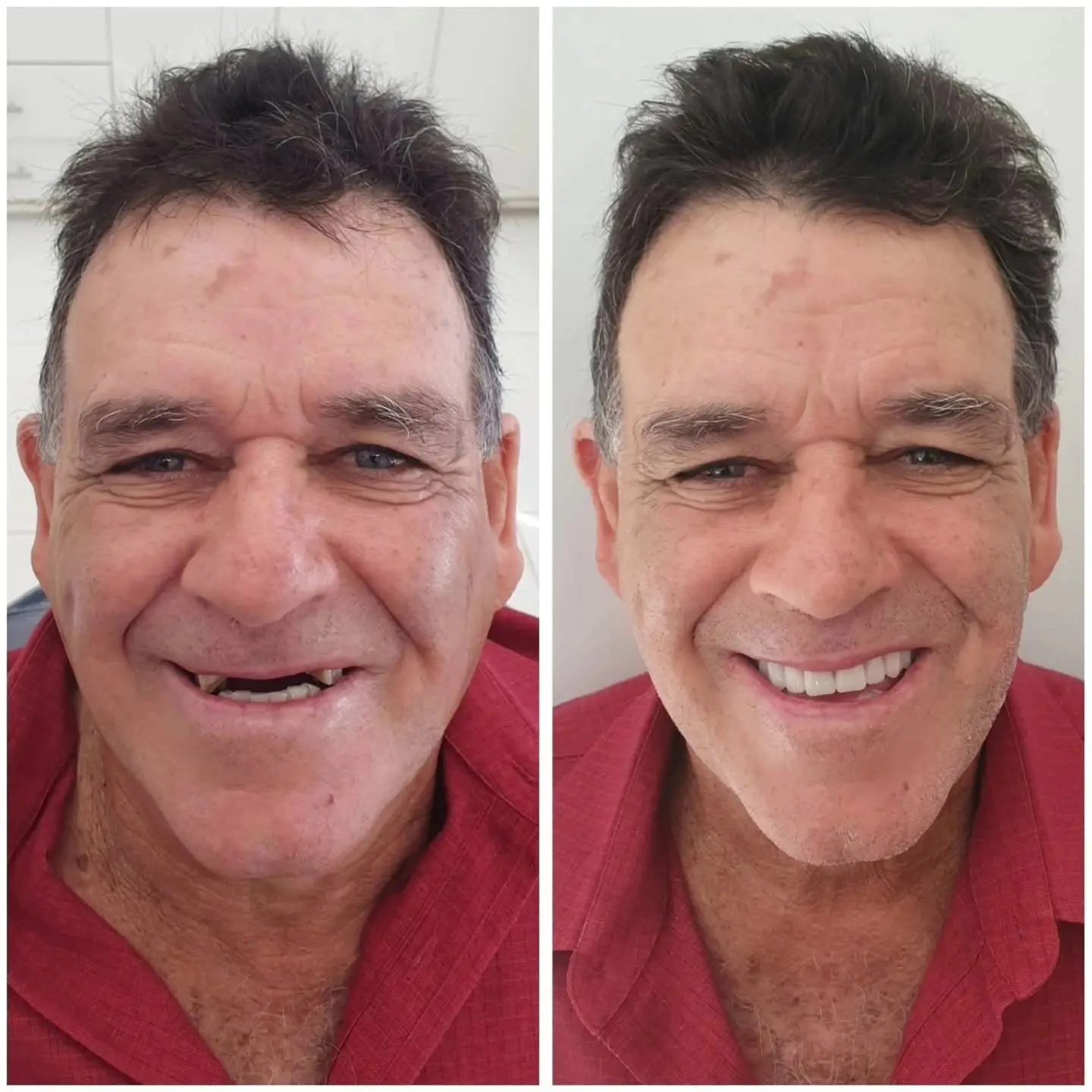 Antes e depois de prótese protocolo — caso 8