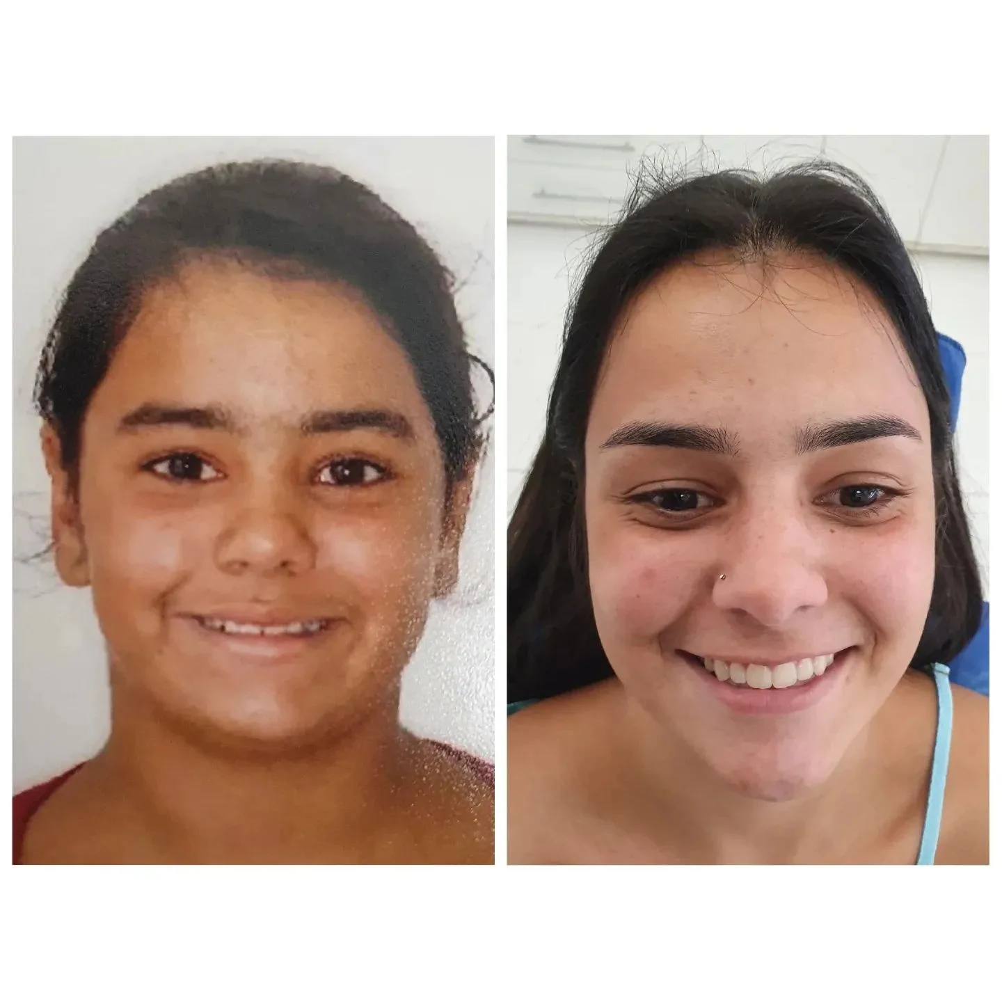 Caso real de tratamento ortodôntico — 16