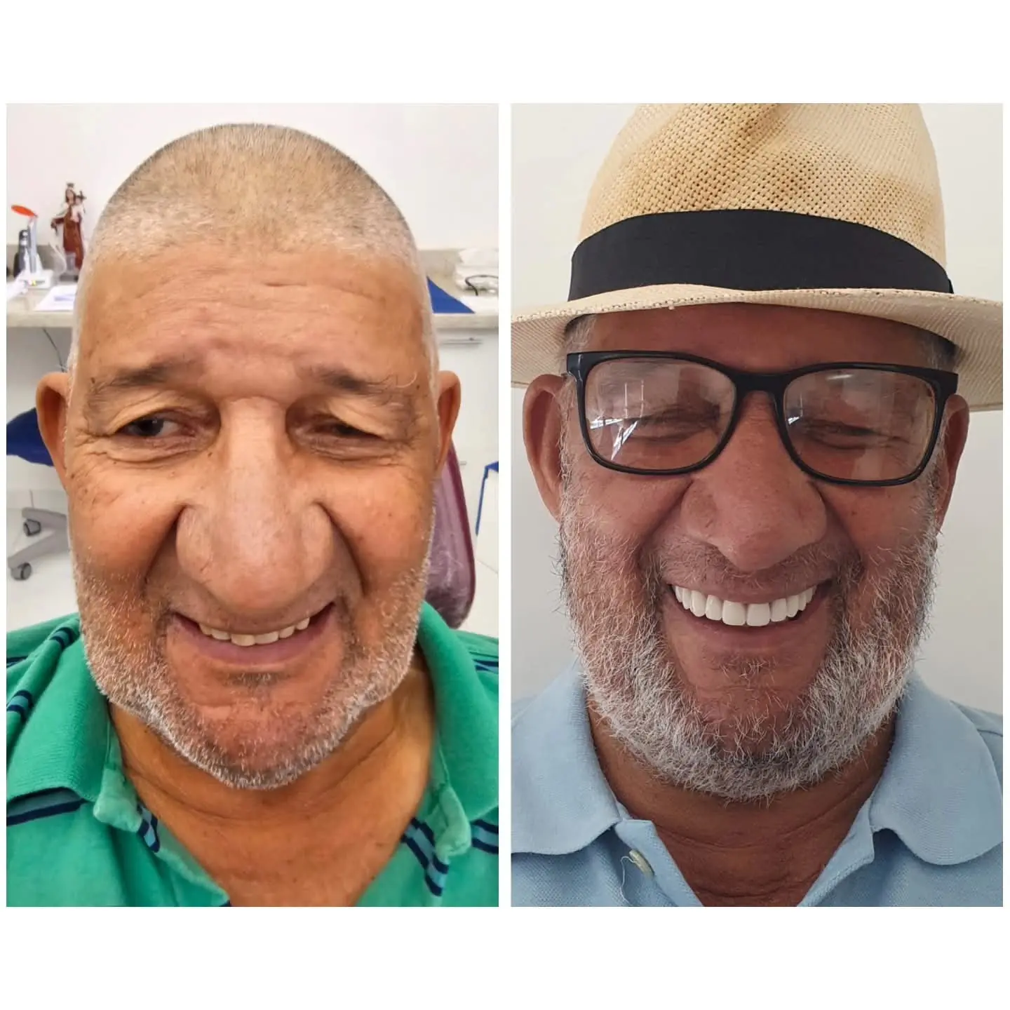 Caso real de prótese protocolo — 14