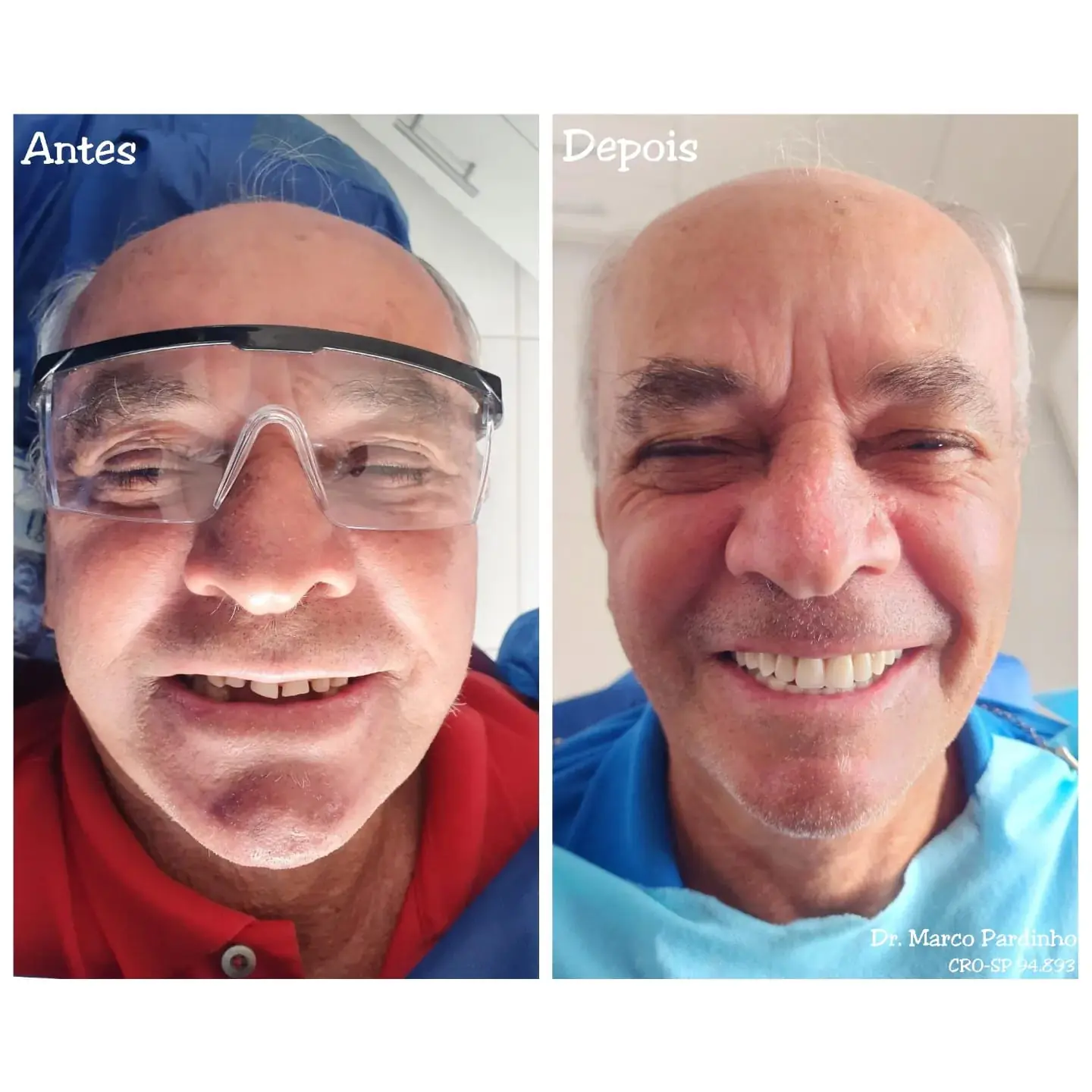 Caso real de prótese protocolo — 17