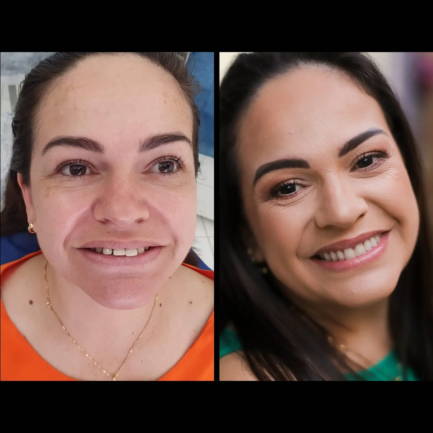 Caso real de prótese protocolo — 18