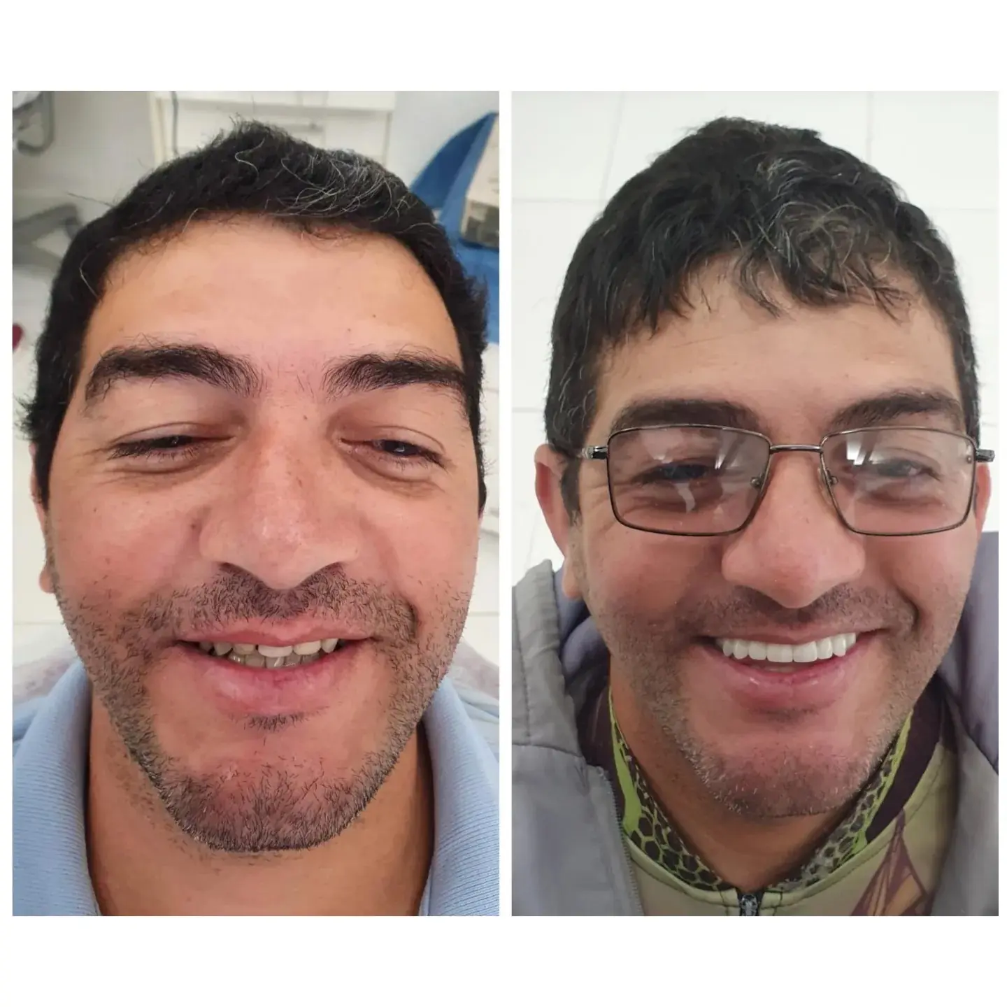 Caso real de prótese protocolo — 22