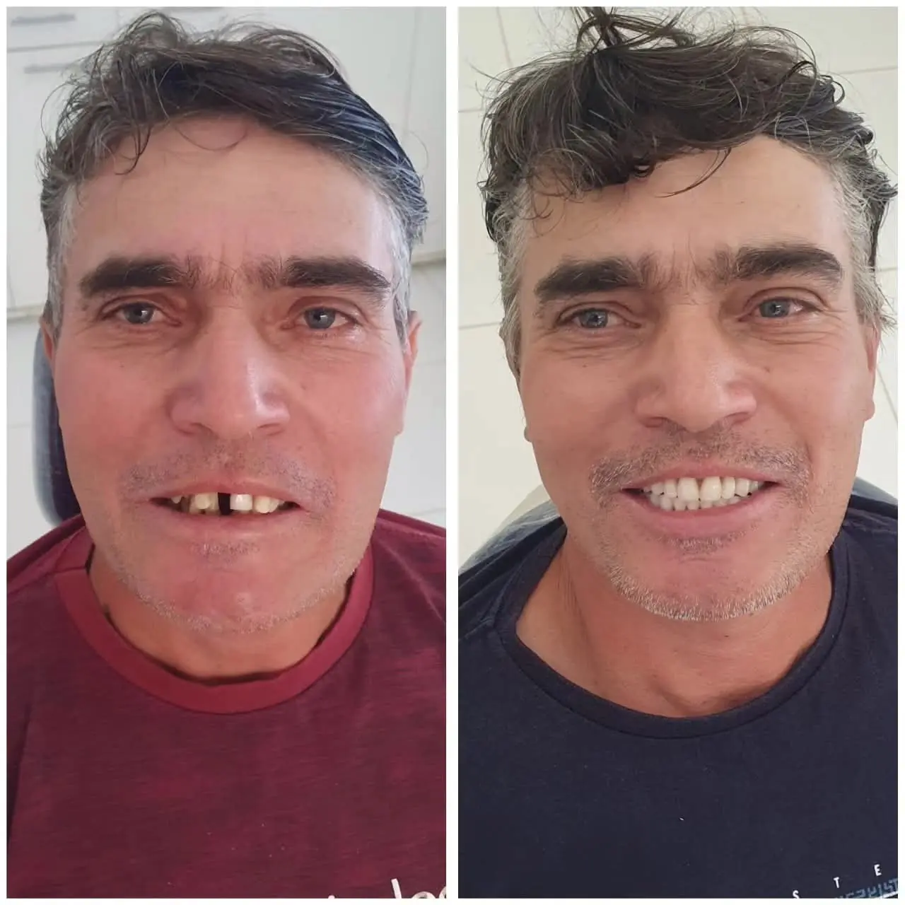 Caso real de prótese protocolo — 23