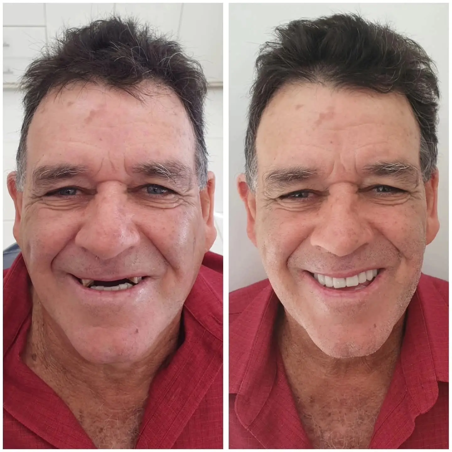 Caso real de prótese protocolo — 28