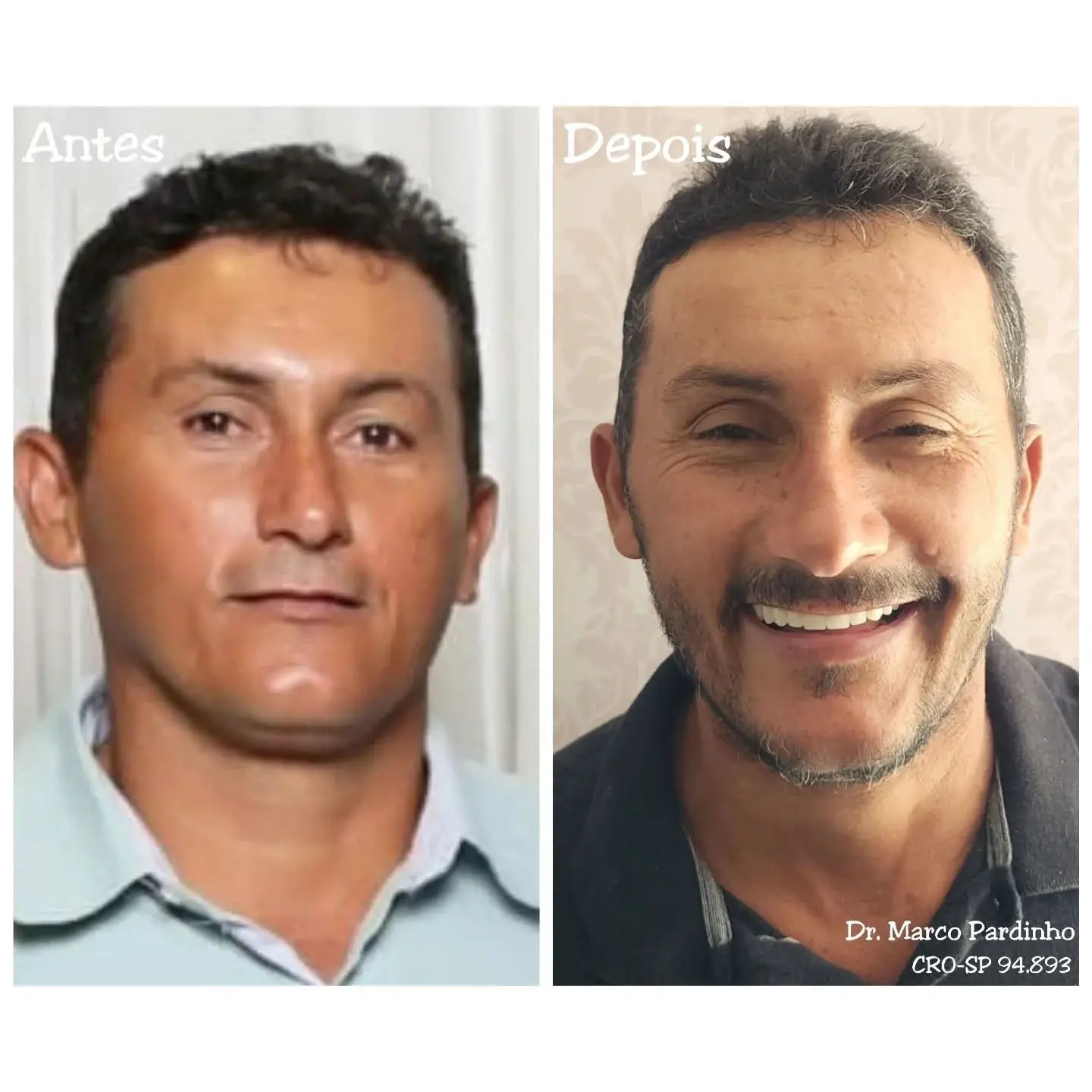 Caso real de prótese protocolo — 33