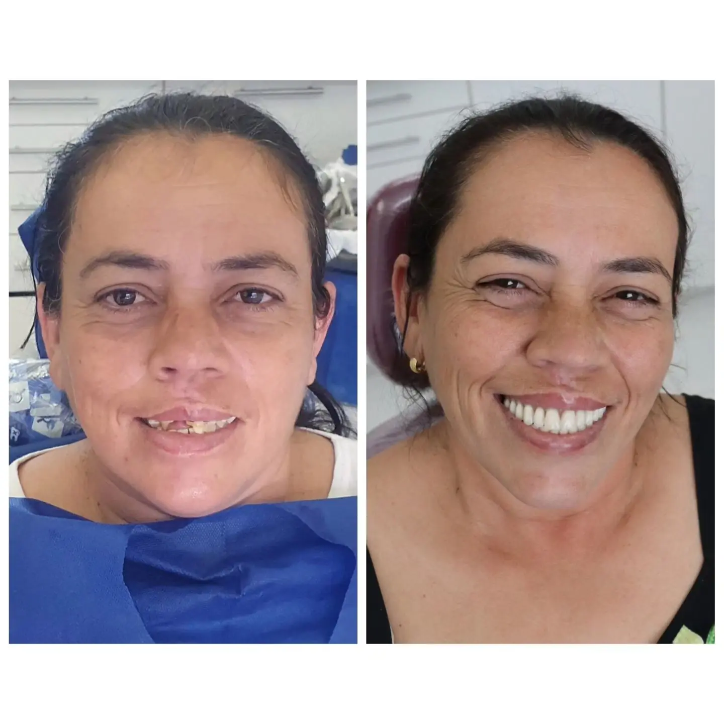 Caso real de prótese protocolo — 36