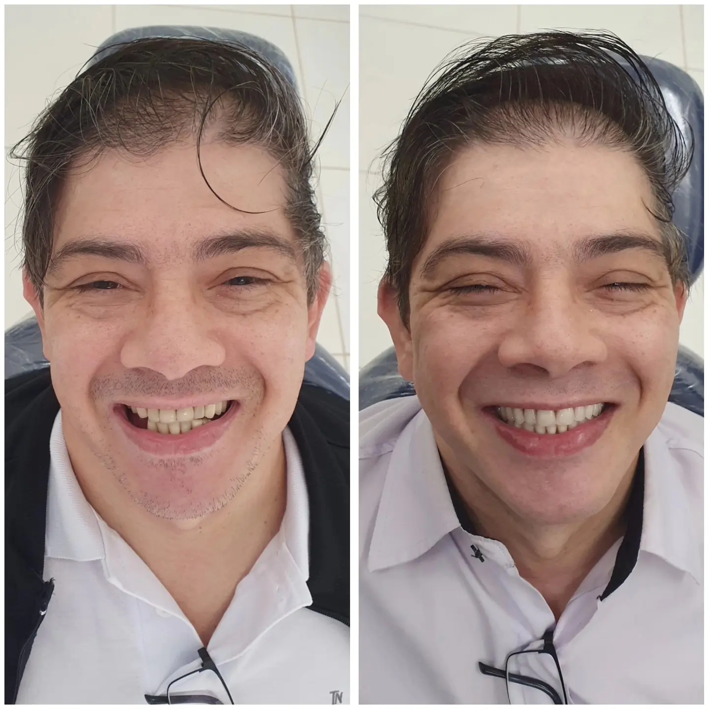 Caso real de prótese protocolo — 40