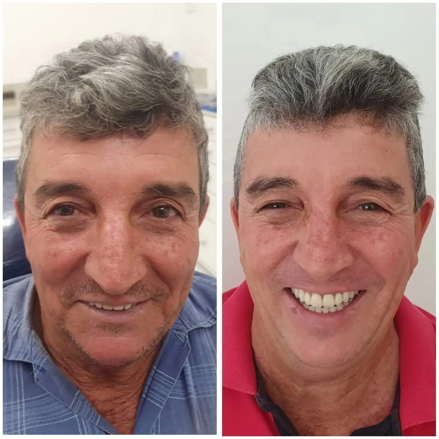 Caso real de prótese protocolo — 45